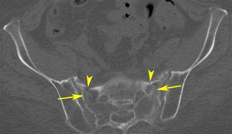 RiT radiology: Sacral Insufficiency Fracture