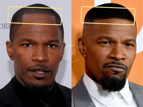 Jamie Foxx Hair Transplant - Hair Loss & Technical Analysis