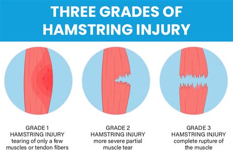 Avoiding Strains and Keeping Your Soccer Athlete Safe - Professional ...