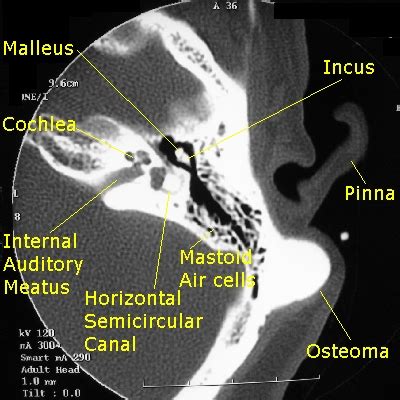 Osteoma CT - wikidoc