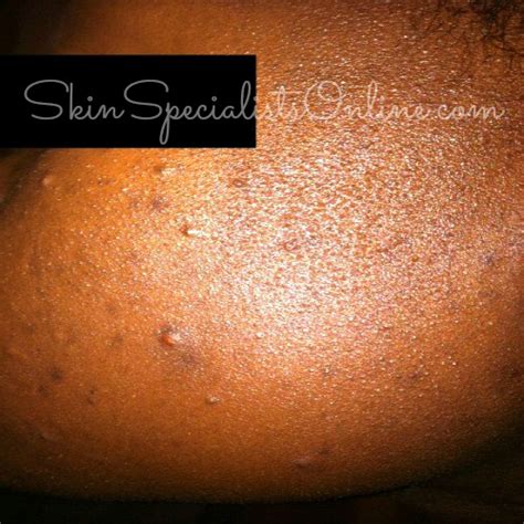 Ask a Skin Specialist: Acneiform Eruptions - Skin Specialists Online