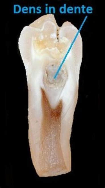 Che cosa è dente invaginatus o il dente nel dente? | Gifted