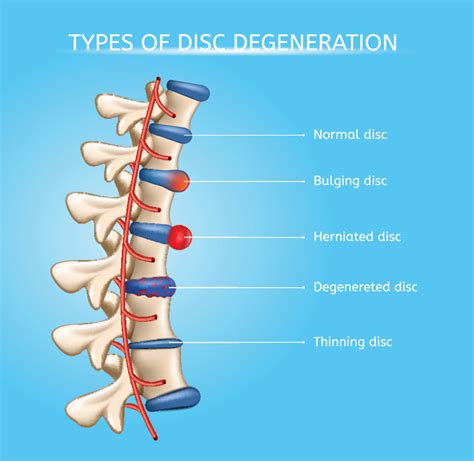 Herniated Disc- what is it and what treatment options are available?