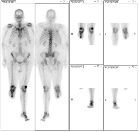 Osteomyelitis Bone Scan