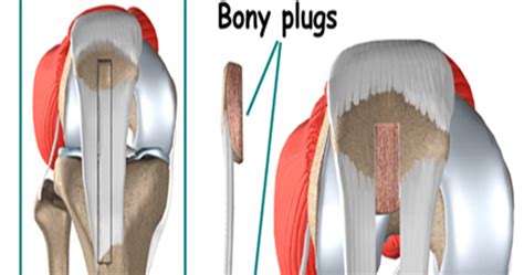 The Shoulder and Knee Doc: ACL SURGICAL NEWS: ALLOGRAFT VS. AUTOGRAFT