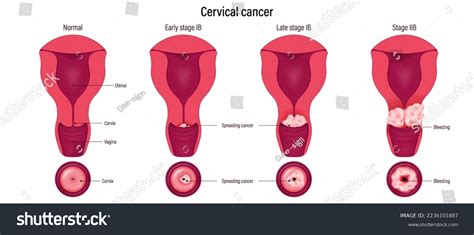 Dysplasia Stages: Over 20 Royalty-Free Licensable Stock Vectors & Vector Art | Shutterstock