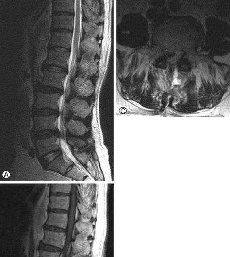 A 75-year-old man with L3-L4 and L4-L5 spinal stenosis. A: T2-weighted... | Download Scientific ...