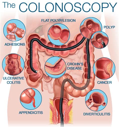 Consideration of colonoscopy ~ Revolution PharmD