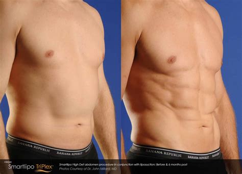 Laser Assisted Liposuction Body Sculpting