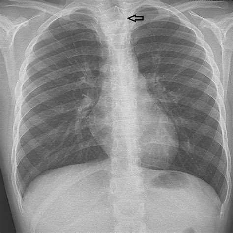 Chest X-ray A clear tracheal deviation can be seen in the chest X-ray. | Download Scientific Diagram