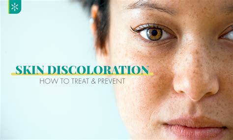 Skin Discoloration: How to Treat & Prevent | LVSCC