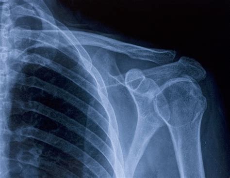 The Facts About Clavicle Fractures in Newborns | Scott Goodwin Law