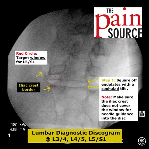 Lumbar Discography - The Pain Source - Makes Learning About Pain, Painless