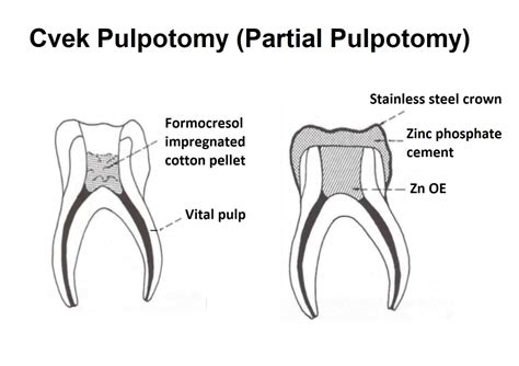 What is Cvek pulpotomy? | News | Dentagama