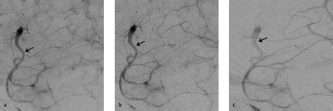 14 Developmental Venous Anomaly | Radiology Key