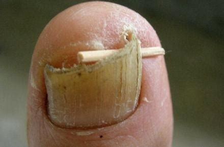 Brittle Toenails And Diabetes | DiabetesTalk.Net