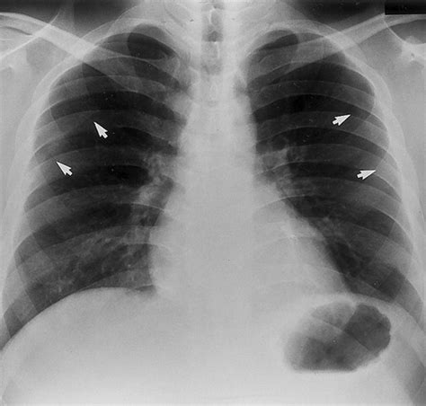 Radiographic and CT Appearances of the Major Fissures | RadioGraphics