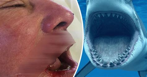 Horrific pictures shows dentist's savaged face after monster shark hit him 'like a truck ...