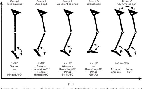 Diplegia | Semantic Scholar