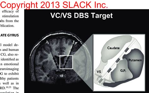 The location of the ventral capsule/ventral striatum (VC/VS) deep brain... | Download Scientific ...