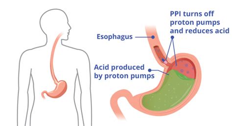 Proton Pump Inhibitors – What Are PPIs & How Do PPIs Work?