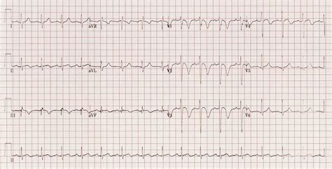 Right Ventricular Strain • LITFL • ECG Library Diagnosis