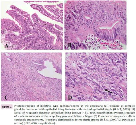 Carcinoma of Ampulla of Vater: Carcinogenesis and Immunophenotyp