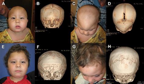 Craniofacial Anomalies | Plastic Surgery Key