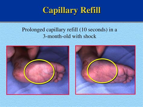 Favorite Tips About How To Check Capillary Refill - Unfuture38