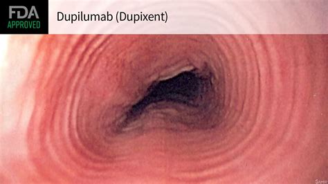 First Treatment Approved for Eosinophilic Esophagitis | MedPage Today