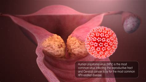 Advancement in Cervical Cancer Treatment - Scientific Animations