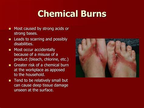 PPT - Burns PowerPoint Presentation, free download - ID:2358828