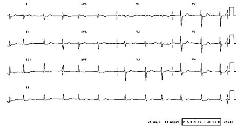 Mitral Stenosis.