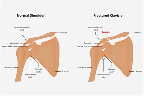 Broken Collarbone In Children: Causes, Symptoms & Treatment