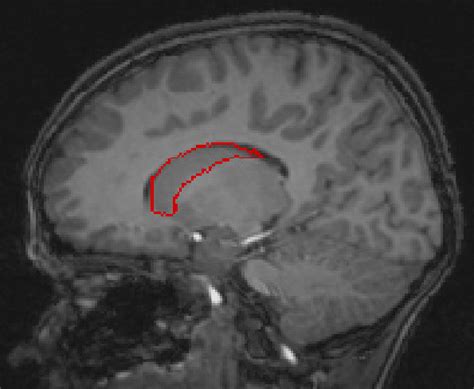 MRI Scan of caudate nucleus. The sagittal MRI scan shows a... | Download Scientific Diagram