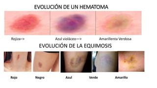 Hematoma y equimosis | PPT