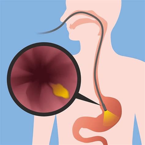 Gastroscopy - Reflux & Swallowing Center