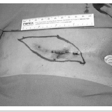 The skin is marked with an elliptical incision, slightly off the... | Download Scientific Diagram