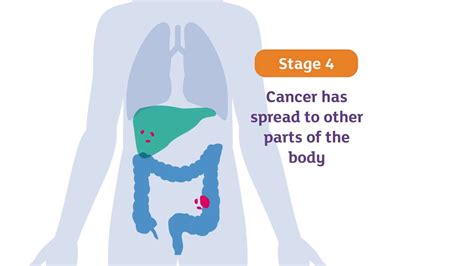 Copd Stages And Timeline