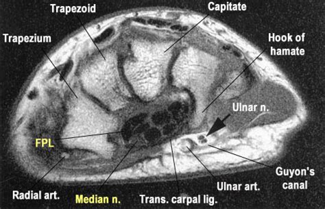 Carpal Tunnel Syndrome - Hand - Orthobullets