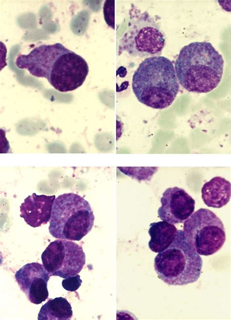 a, 4b-Clusters of plasma cells with azurophilic granules (MO-MGG, 100x... | Download Scientific ...