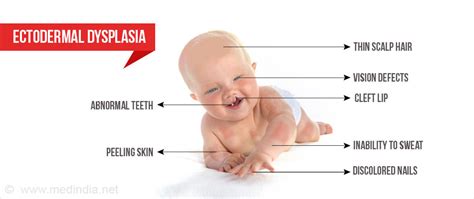 Ectodermal Dysplasia - Types, Causes, Symptoms, Diagnosis, Treatment