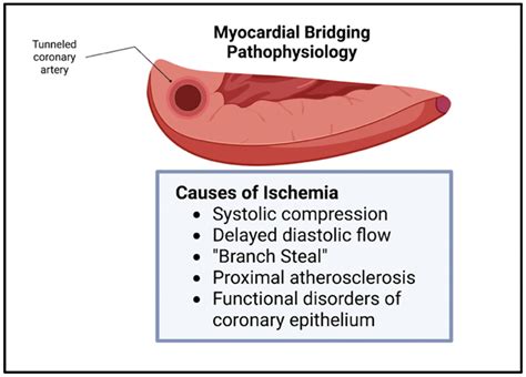 Genes | Free Full-Text | A Contemporary Review of the Genomic Associations of Coronary Artery ...