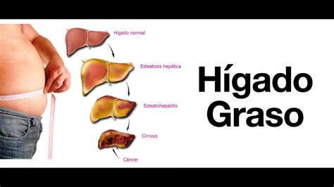 Hígado graso: Síntomas, Diagnóstico, Tratamiento y Prevención ...