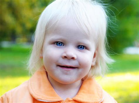 Albinism - Ocular, Types, Facts, Causes, Symptoms, Treatment, Genetics | Diseases Pictures