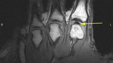 Solving the Mystery of Knuckle Cracking | California Academy of Sciences