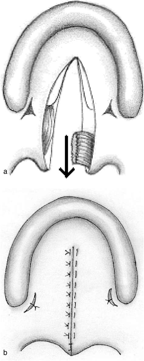 Figure 2 from Speech Results after One-Stage Palatoplasty with or without Muscle Reconstruction ...