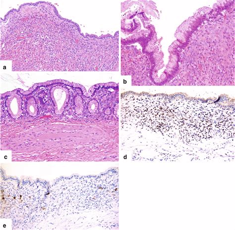 Mucinous Cystic Neoplasm of the Pancreas (MCN) | Radiology Key