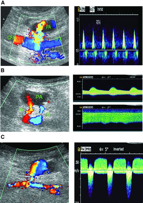 Femoral Av Fistula Ultrasound