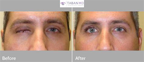 Prosthetic Eye & Socket Surgery Before and After Photos | Taban MD